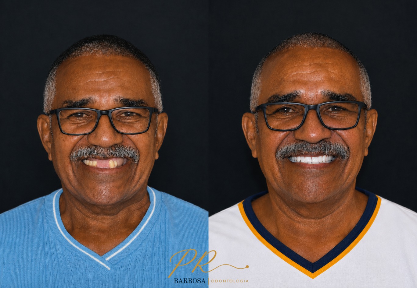 Caso Clínico 2 - Transformação do Sorriso e Estética Oral PR Barbosa